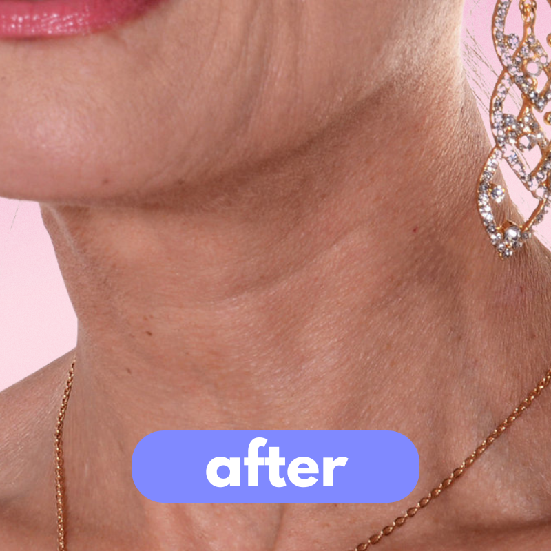 the instalift - neck lift